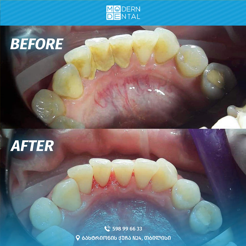 The patient underwent a 4-stage cleansing